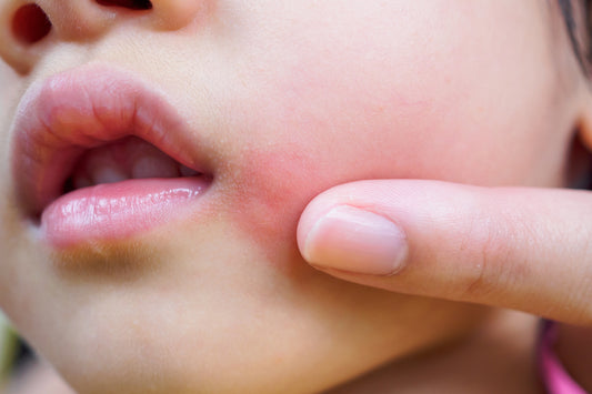 Eczema on Children's Skin